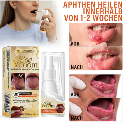 ✅Offizieller Store | Ourlyard™ Bienenwachs Antibakterieller & Anti-Warzen Mundspray 🧑🏼‍⚕️ Empfohlen von der Deutschen Gesellschaft für Zahngesundheit (DGZ)🍀